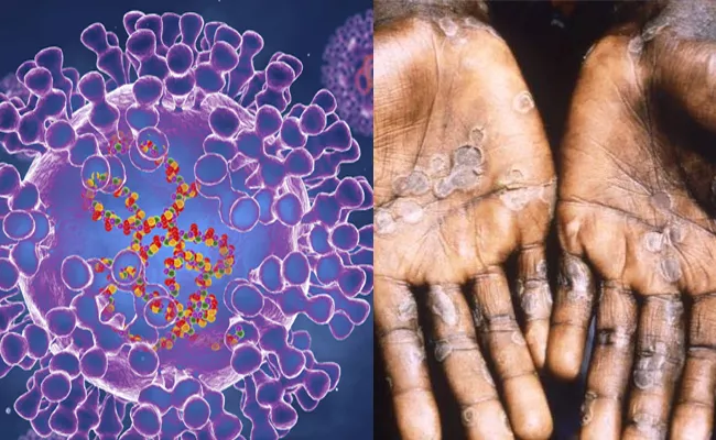 Monkeypox Outbreak UK US Caused By Possible Sexual Transmission - Sakshi