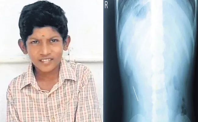 Boy Accidentally Swallowed Pin At Hosur Karnataka - Sakshi